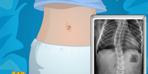 Operate Now! Scoliosis Surgery